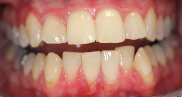 Schwangerschaft und Mundgesundheit, nach der Dentalhygien